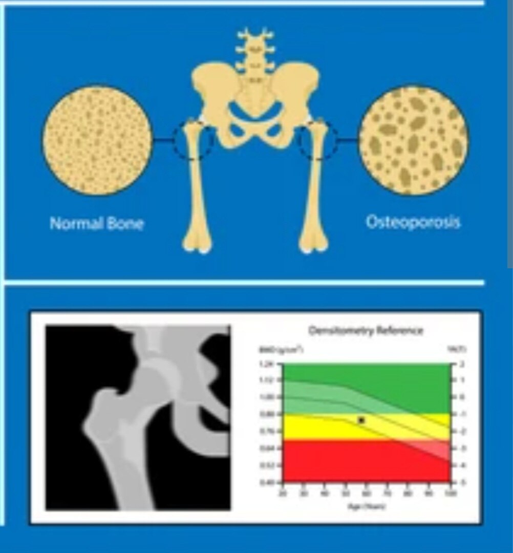 A318➡️Osteoporosis Profile - 3