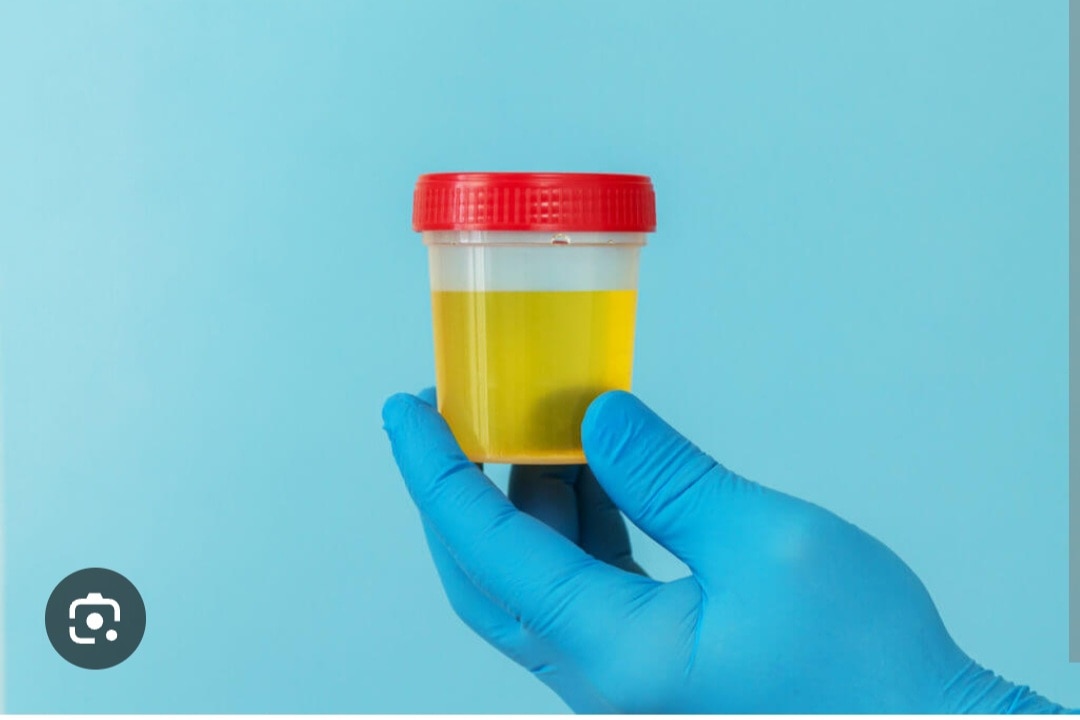 A323➡️Proteins, Urine 24 Hrs