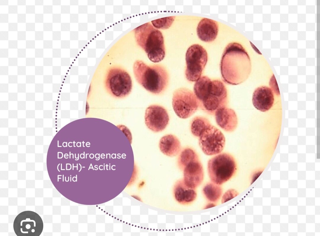 A327➡️LDH (Lactate Dehydrogenase), Ascitic Fluid