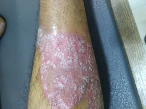 Psoriasis Care  service image