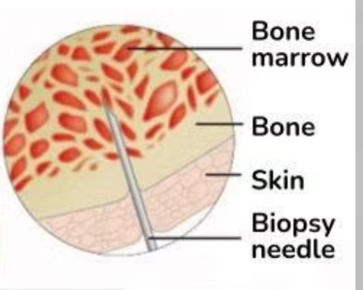 A371➡️Histopathological Examination - Bone Marrow Trephine biospy