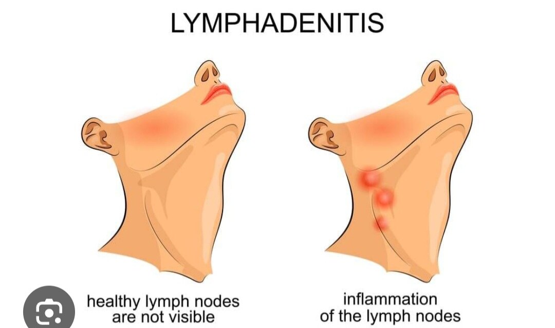 A372➡️Histopathological Examination - Lymph Node Biopsy