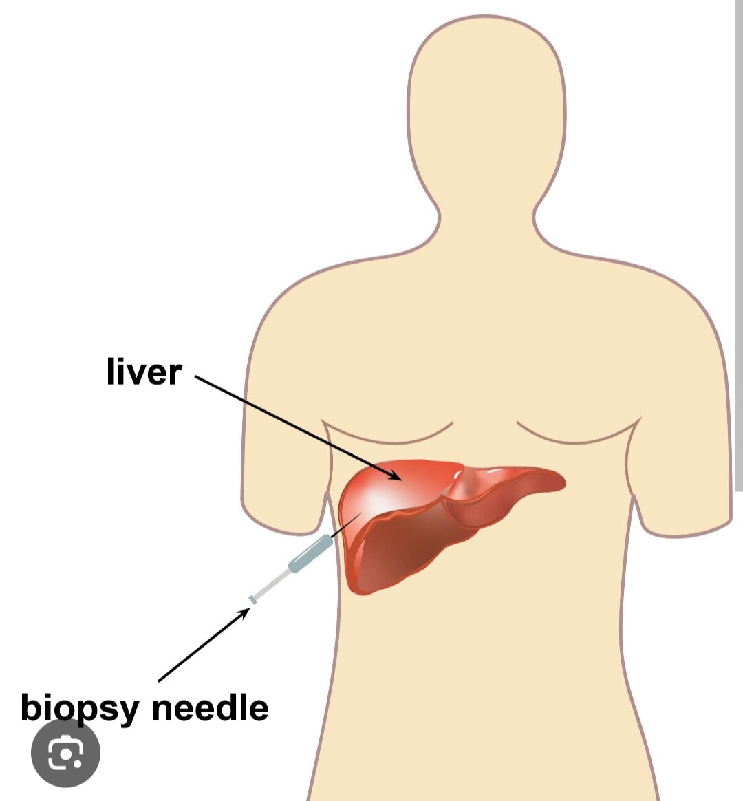 A373➡️Histopathological Examination-Liver Biopsy