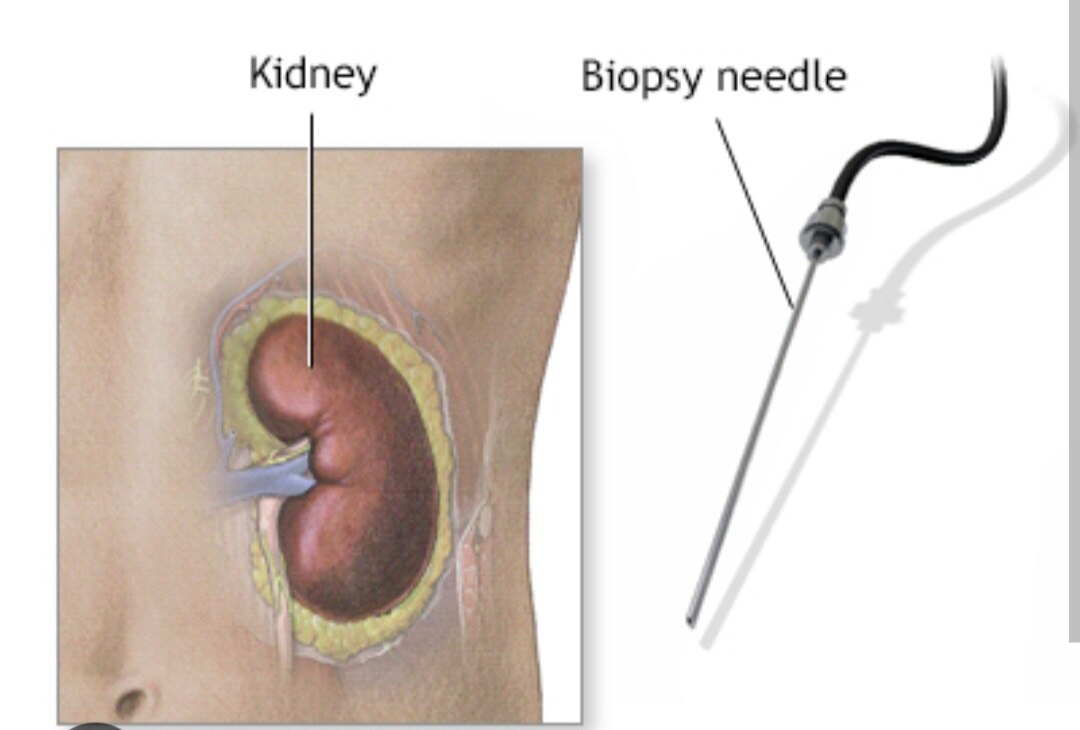 A374➡️Kidney Biopsy For Medical Renal Desease