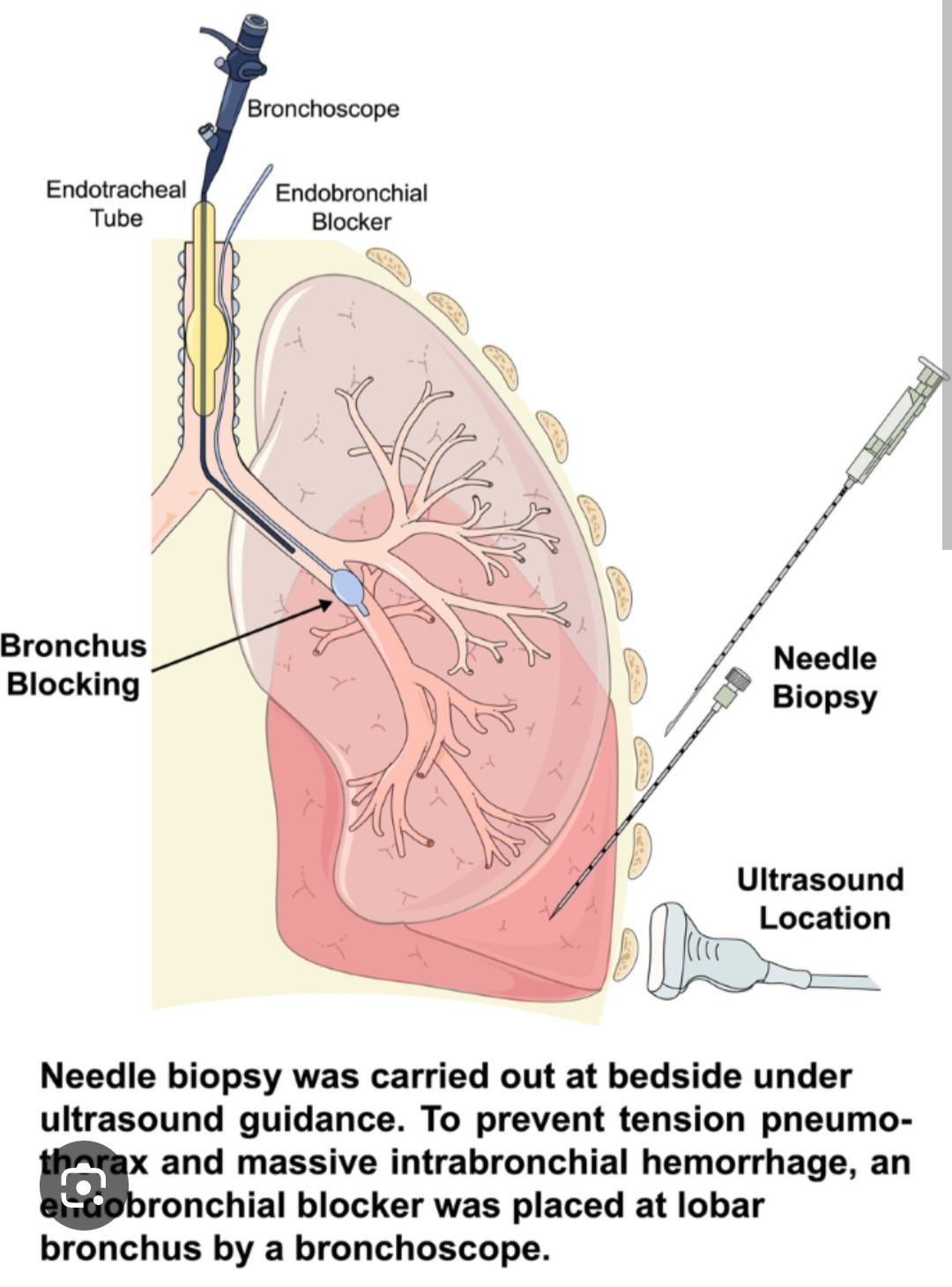 A375➡️Histopathological Examination-lung Biopsy 