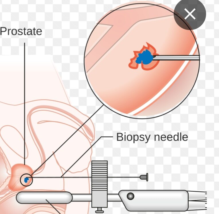A377➡️Histopathological Examination-prostate Trucut Needle Biopsy 