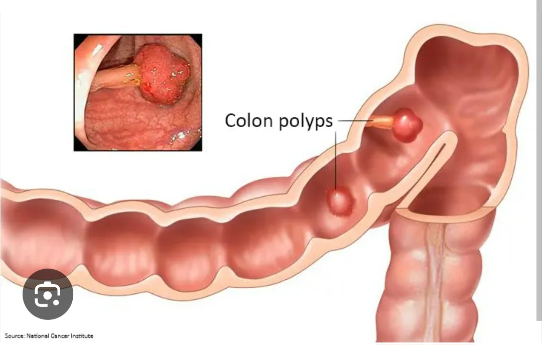 A378➡️Colon Biopsy 