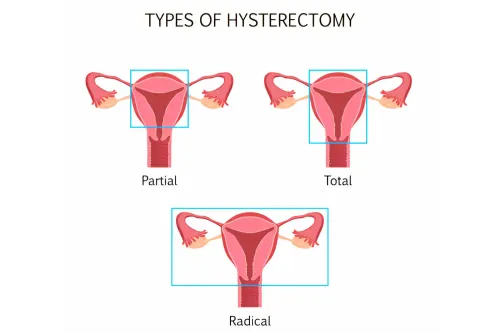 Hysterectomy product image