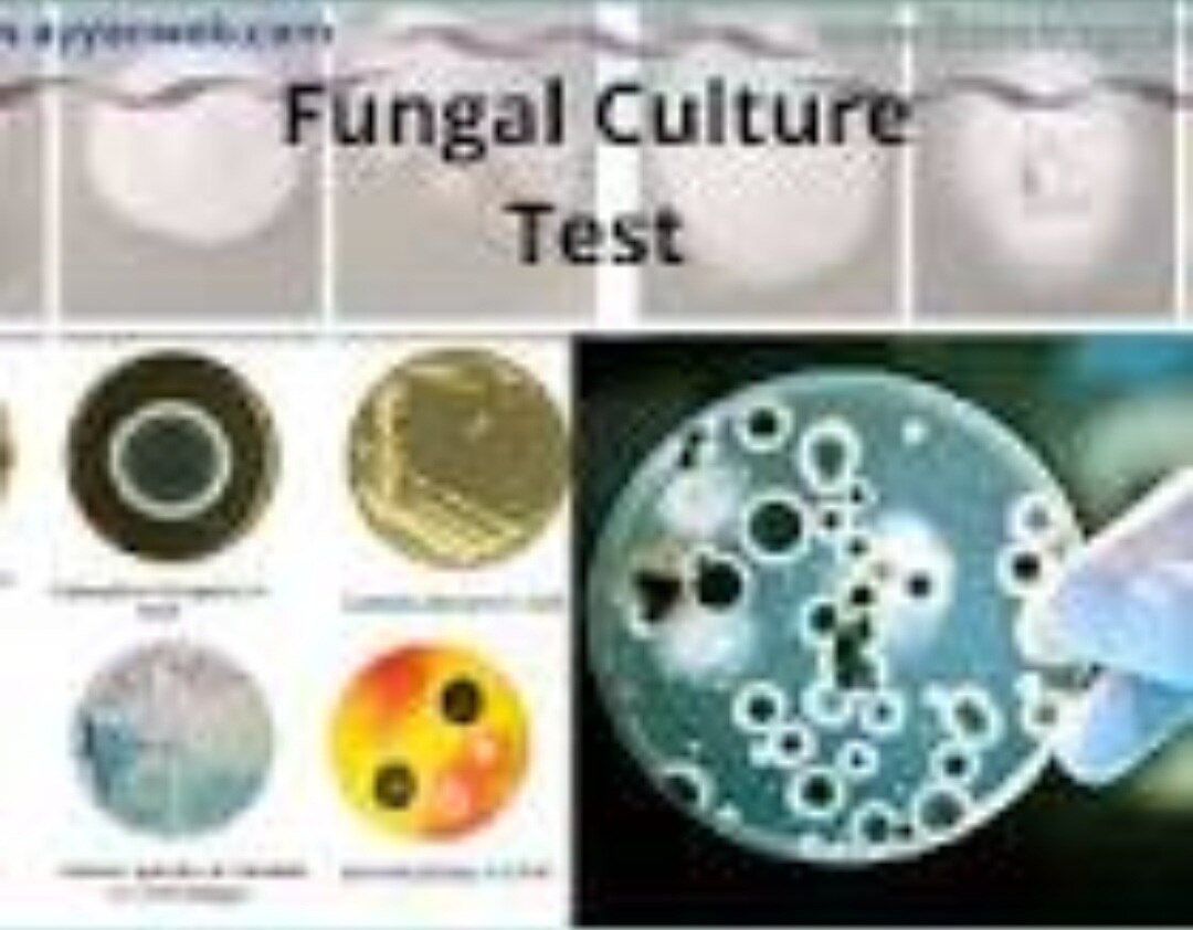 A402➡️Fungal stain, Culture & Identification, Bone Marrow