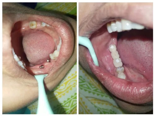 Dental Implants  product image