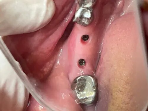 Tooth Implant  treatment in Kharadi , Wadgaon Sheri service image