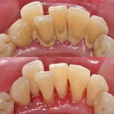 Teeth cleaning n polishing product image