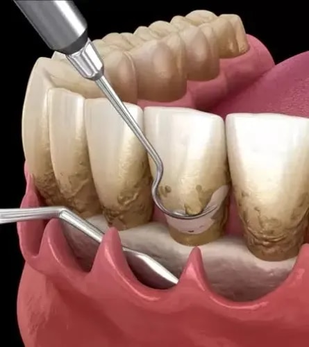 Gum surgery product image
