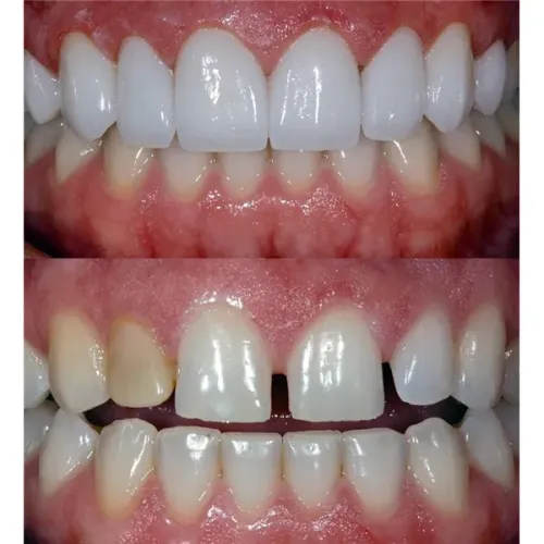 Porcelain veneers and crowns service image