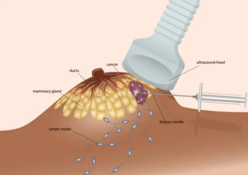 Breast Conservative Surgery service image