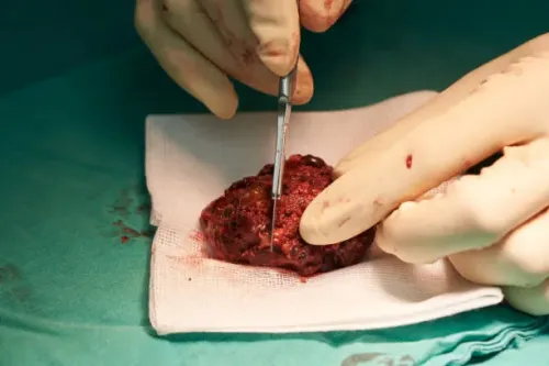 Fibroadenoma Excision service image