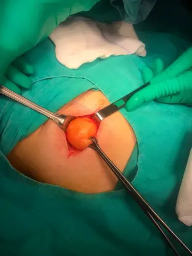 Hydatid Cyst Excision service image