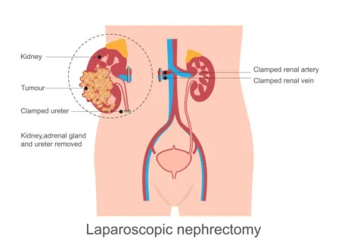Laparoscopic Nephrectomy service image