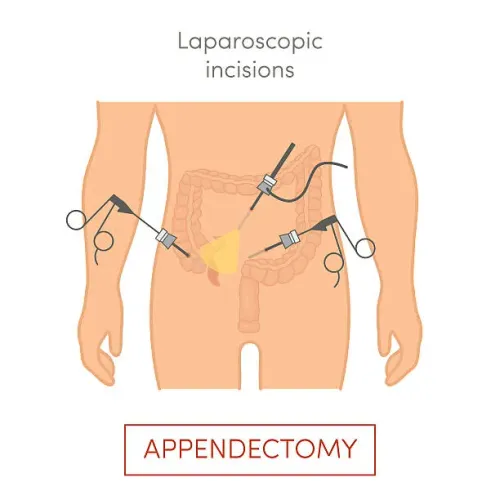 Laparoscopic Adrenalectomy service image