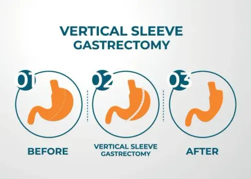 Laparoscopic Gastrectomy service image