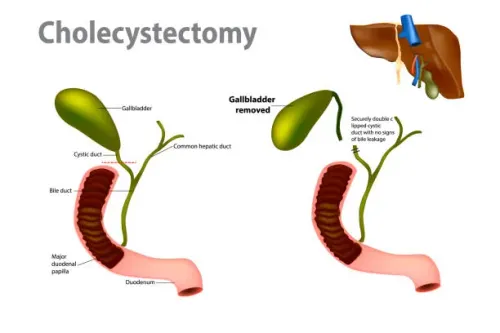 Laparoscopic Cholecystectomy service image