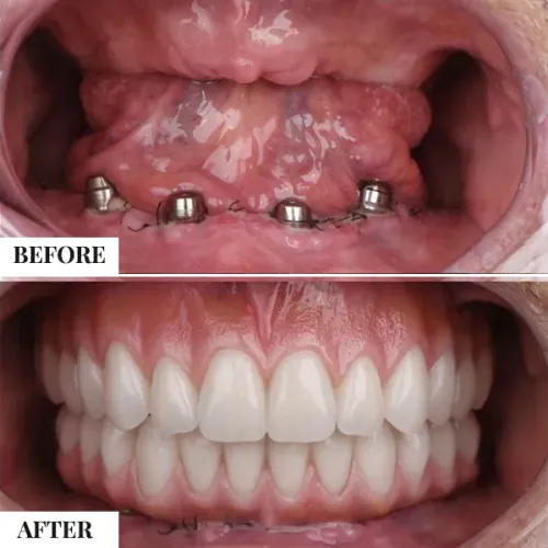 Basal implants service image