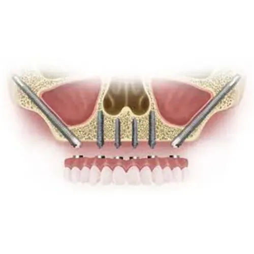 Zygomatic Implants service image