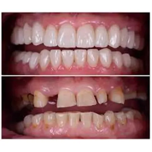 Full mouth rehabilitations service image