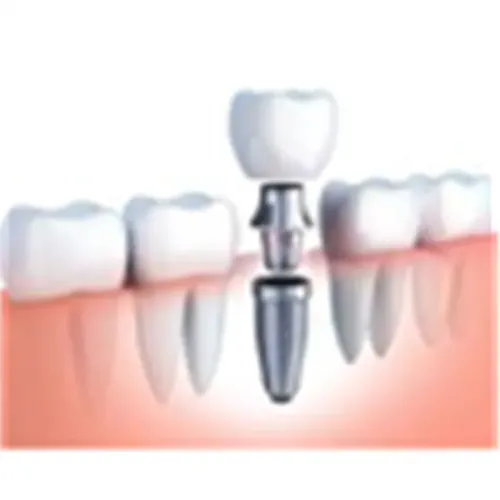 Bone Grafting service image