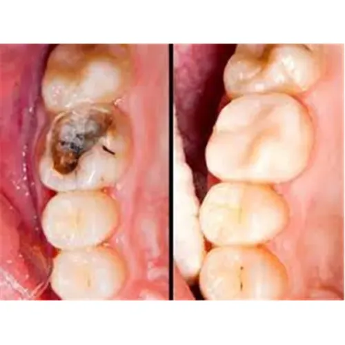  Restorative fillings service image