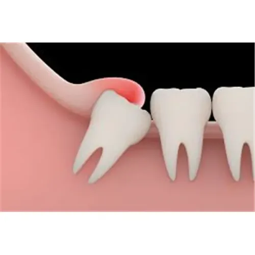 Wisdom tooth removal service image