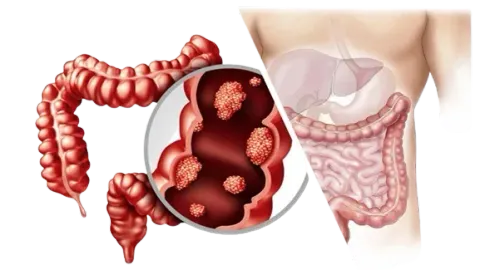 Colorectal Cancer Surgeon in Mahim,Mumbai service image