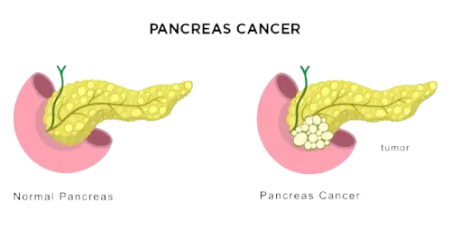 Hepatobiliary Pancreatic Cancer Surgeon in Mahim,Mumbai service image