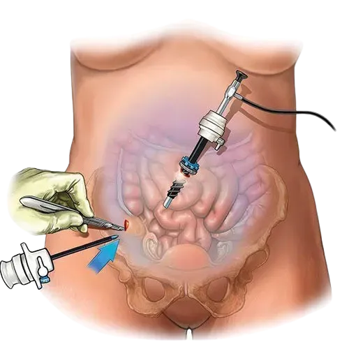 Laparoscopic Cancer Surgeon in Mahim,Mumbai service image