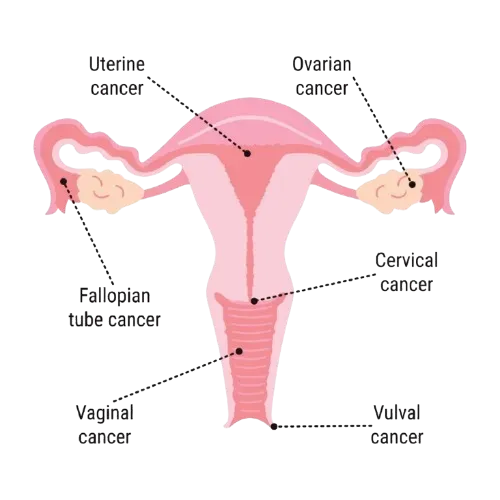 Gynecological Cancer Surgeon in Mahim,Mumbai service image