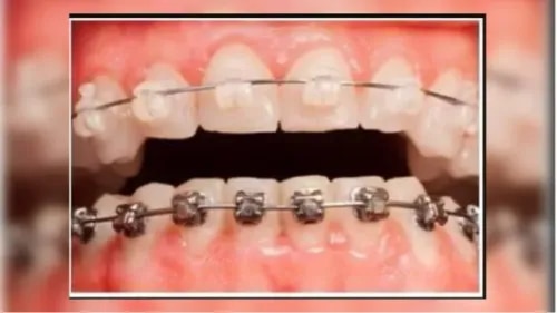 Fixed Orthodontic Braces  service image