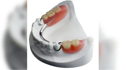 Cast Partial Dentures (RPD) service image