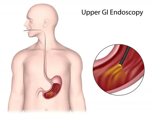 Upper GI Scopy service image