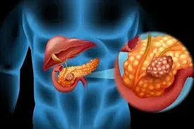 Pancreatic Cancer Surgery service image