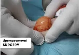 Lipoma Surgery service image