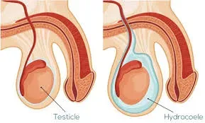 Testicular Swelling Surgery  service image