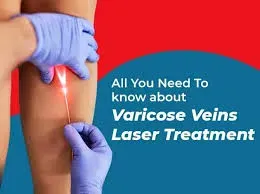 laser Varicose Vein Surgery service image