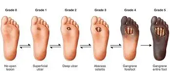 Diabetic Foot Surgery service image