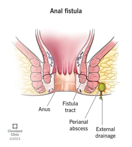 Fistula Surgery service image