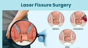laser Fissure Surgery service image