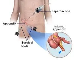 Appendix Surgery service image