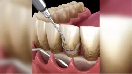 Flap Surgery service image