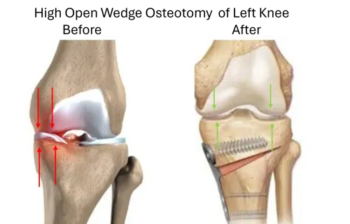 Osteotomy In Dadar service image