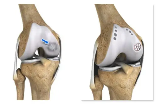 Joint Preservation Surgery In Dadar service image