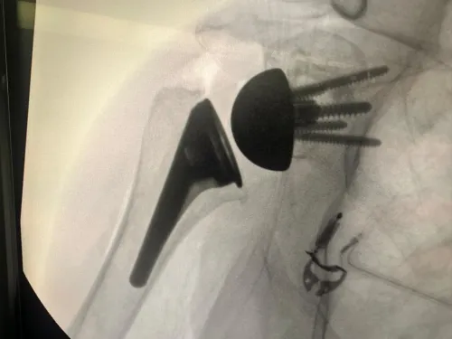 Shoulder Surgery In Dadar service image